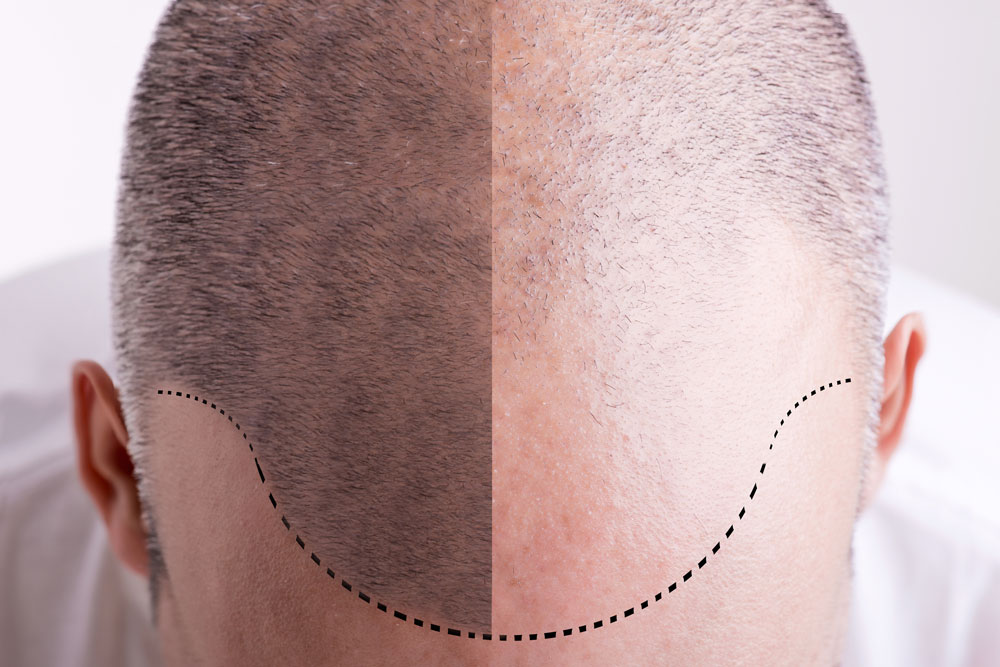 Hair Transplant in Bangladesh, Hair Transplant Cost